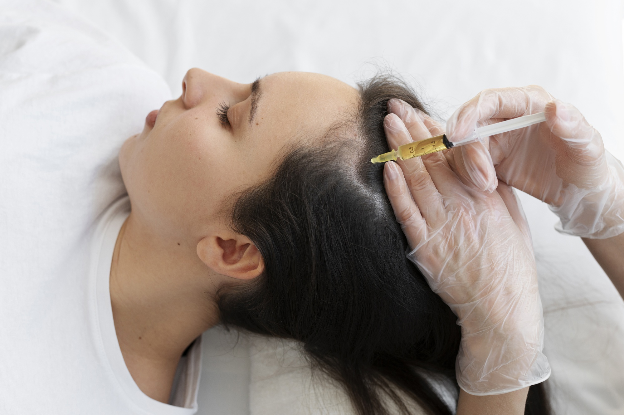 PRP Hair Treatment at HMS Fat Freezing for hair restoration and hair growth