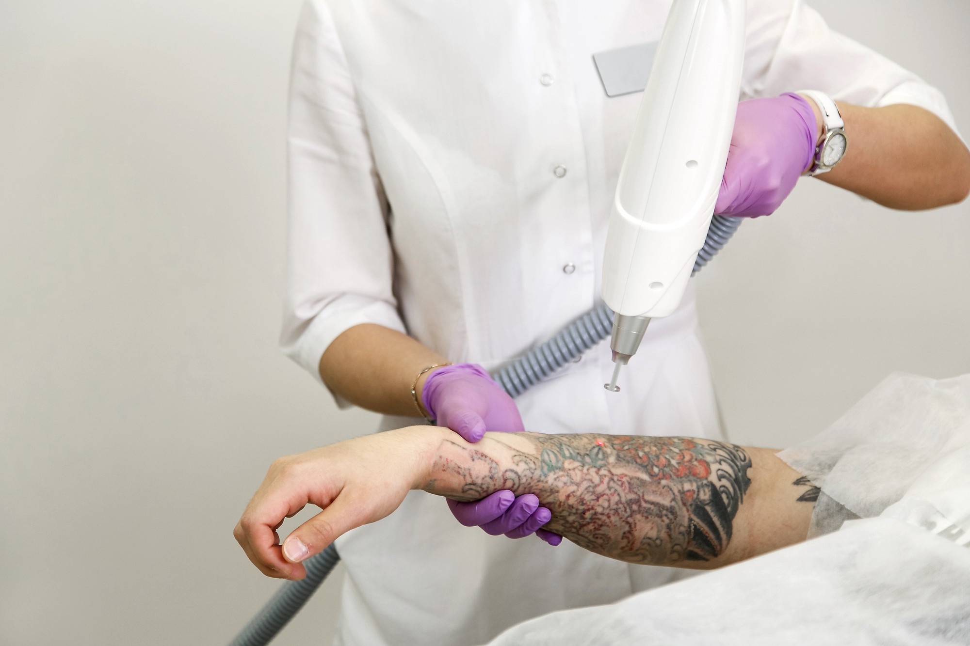 Laser Tattoo Removal Treatment performed on unwanted tattoo pigment in Dubai