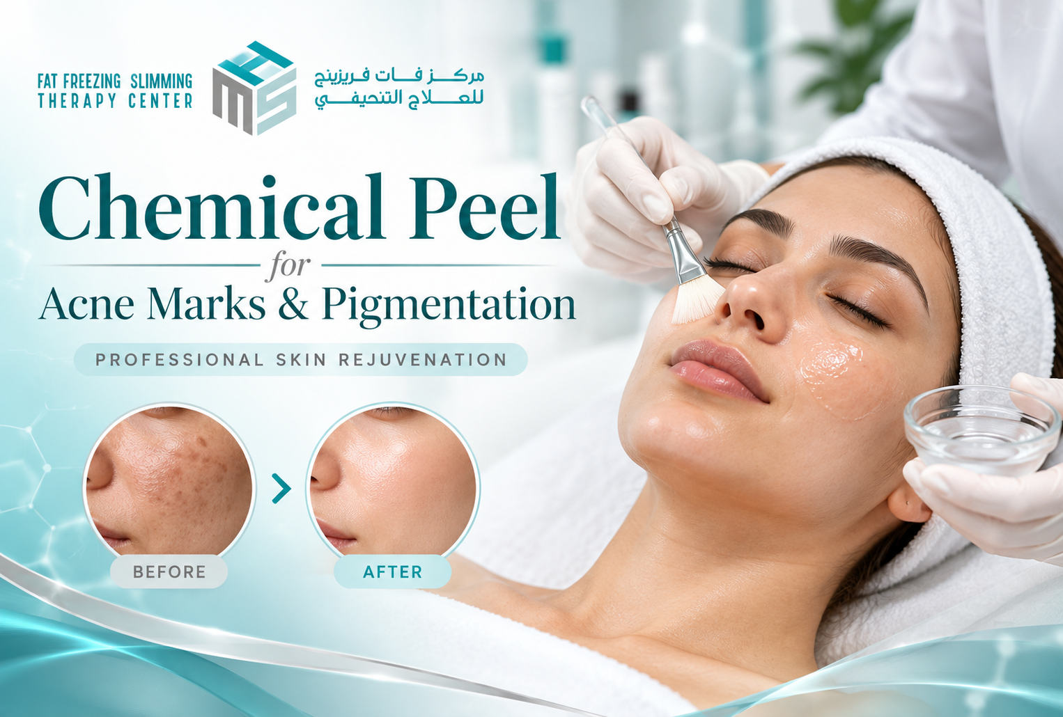 Professional chemical peel treatment for acne marks, dark spots and uneven skin pigmentation in Dubai