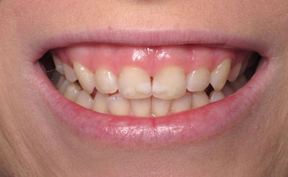 smile 6 1